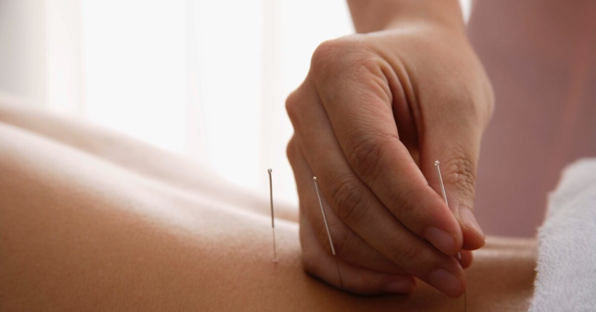 The Role of Acupuncture in Managing Chronic Health Conditions